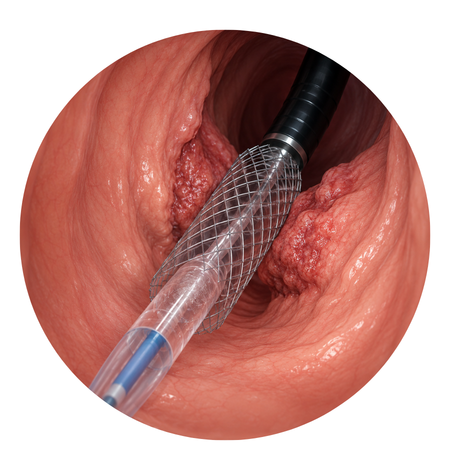 Endoscopic Stent Placement